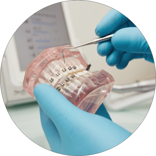 Orthodontics   Types of Braces